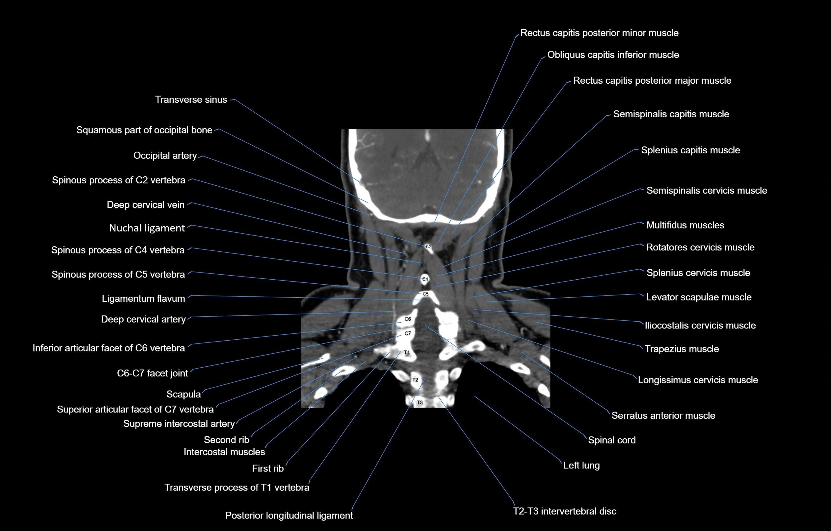 CT Neck coronal  cross sectional anatomy labelled 3D  radiology  image-00051.webp